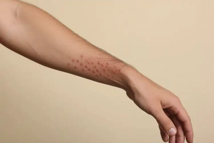 青年人四肢長濕疹能不能徹底自愈(圖4)