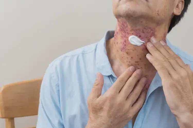 男性脖子上有濕疹不管它會自己好嗎(圖2)