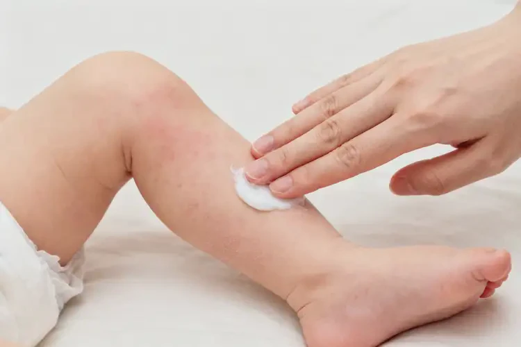 嬰兒小腿有濕疹不管它會(huì)自己痊愈嗎(圖1)