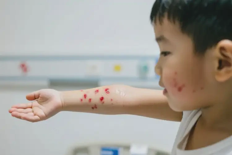 少儿手臂上经常起湿疹不管它会自己好吗(图4)