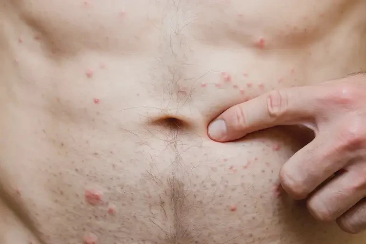 男人肚子上偶爾起濕疹不管它會自己好嗎(圖4)