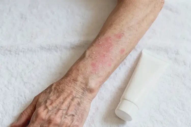 老人手臂偶爾起濕疹不管它會自己好嗎(圖3)