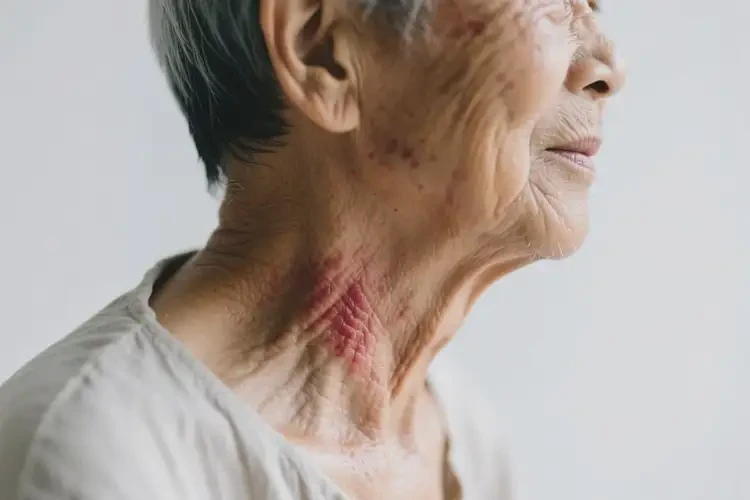 高齡老人脖子上經(jīng)常長(zhǎng)濕疹不管它會(huì)自己痊愈嗎(圖2)