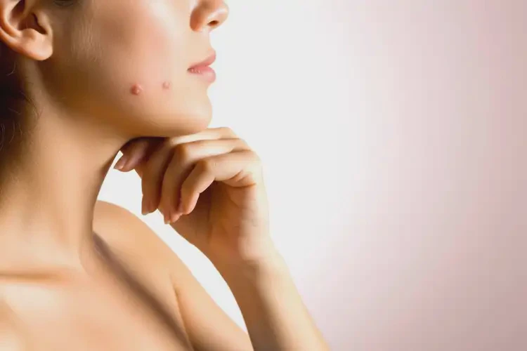 孕妇面部经常长湿疹可不可以彻底自愈(图3)