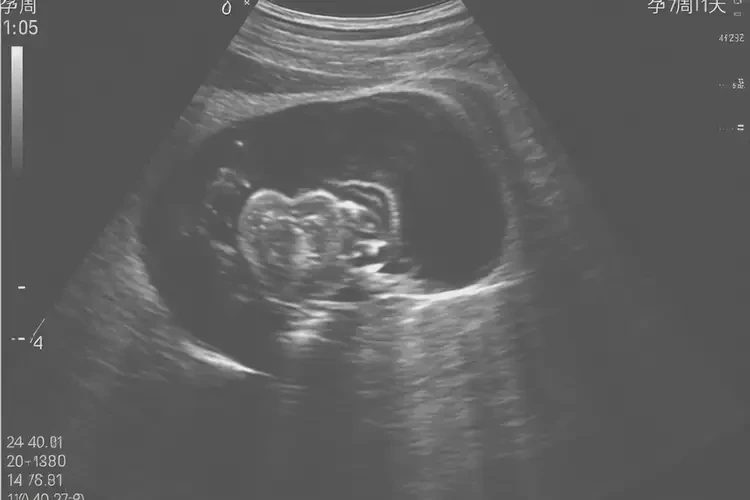 孕7周1天胎心率168怎么回事(圖3)