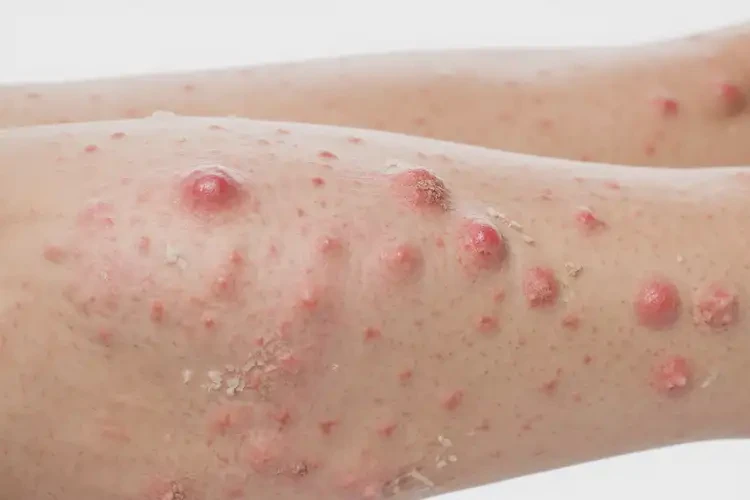 女人小腿上有濕疹不管它會自己好嗎(圖4)