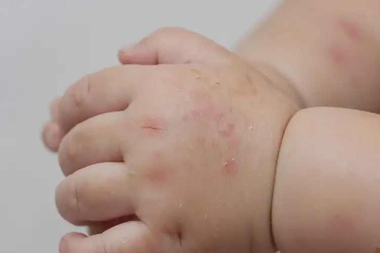 幼兒肛周起濕疹可不可以徹底自愈(圖4)