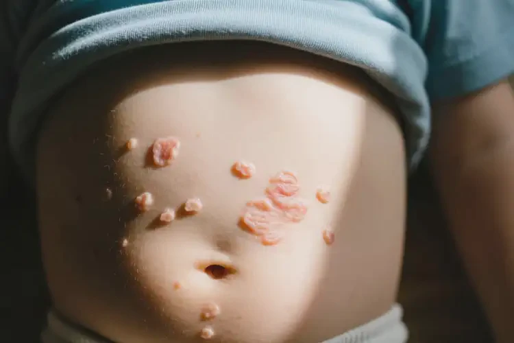 小孩肚子上長濕疹可以徹底自愈嗎(圖2)