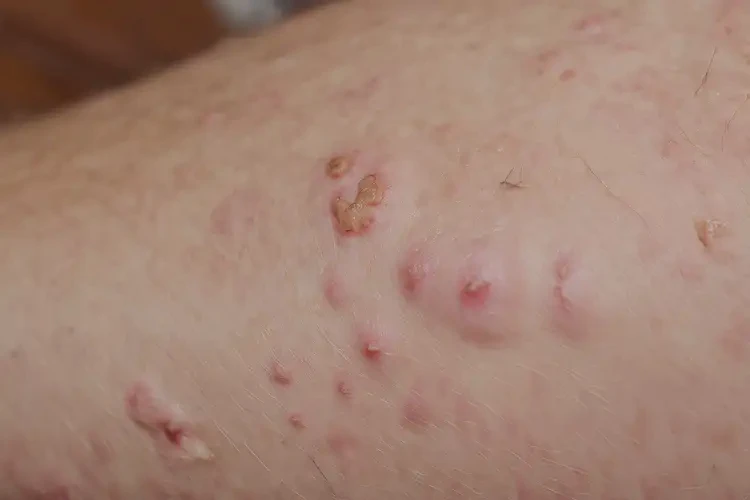 青少年手上起湿疹能靠自己自愈吗(图4)