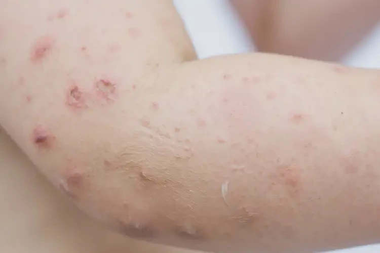 孩子手臂容易起濕疹能徹底自愈嗎(圖4)