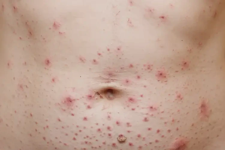 女人肚子長濕疹不管它會自己自愈嗎(圖4)