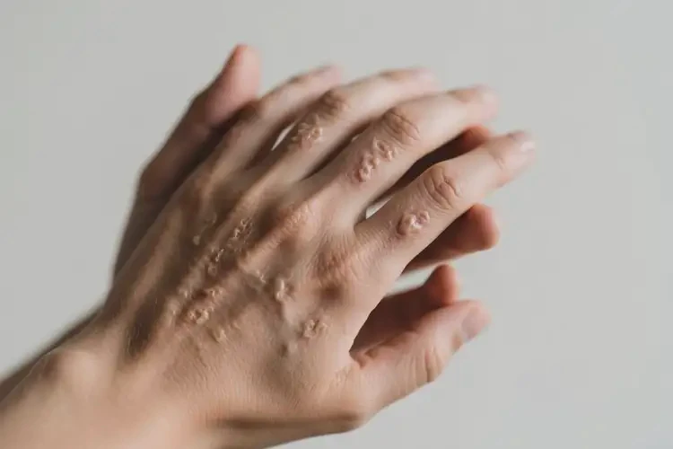 青年人手上出现湿疹不管它会自己好吗(图1)