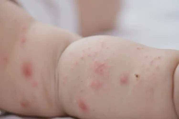 寶寶手臂有濕疹不管它會(huì)自己自愈嗎(圖4)