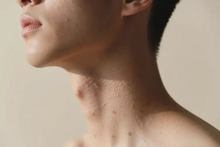 青年人脖子偶爾起濕疹可以徹底自愈嗎(圖4)