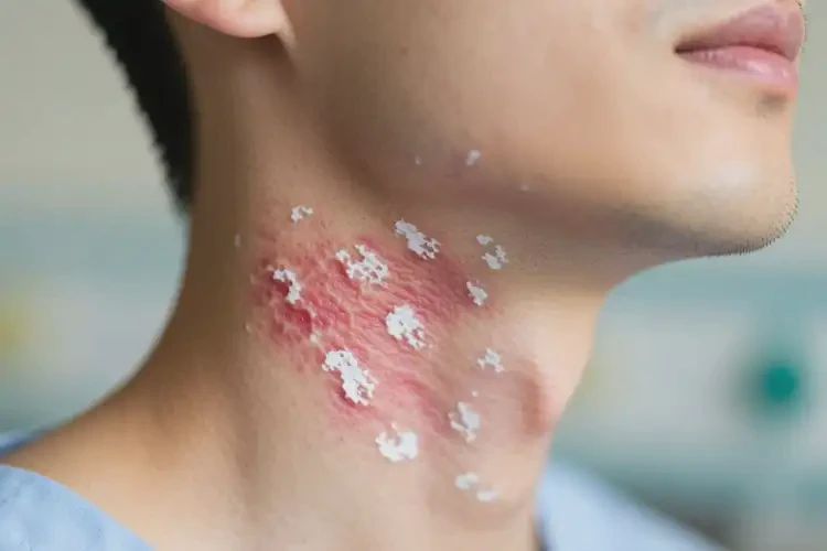 男性脖子出濕疹可不可以徹底自愈(圖3)