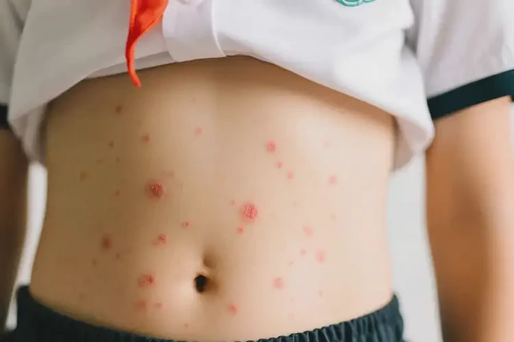 小學(xué)生肚子上偶爾長濕疹可以徹底自愈嗎(圖3)