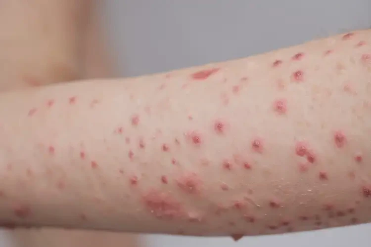 兒童手臂容易起濕疹不管它會自己好嗎(圖4)