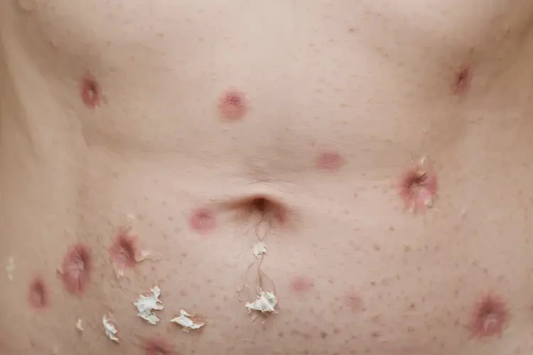 女性肚子經(jīng)常長濕疹不管它會自己好嗎(圖4)