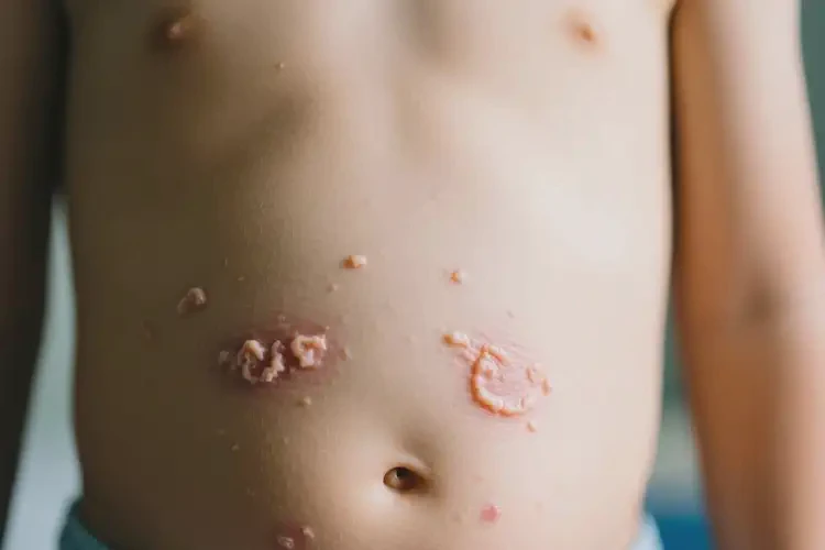 小孩肚子上長濕疹可以徹底自愈嗎(圖4)