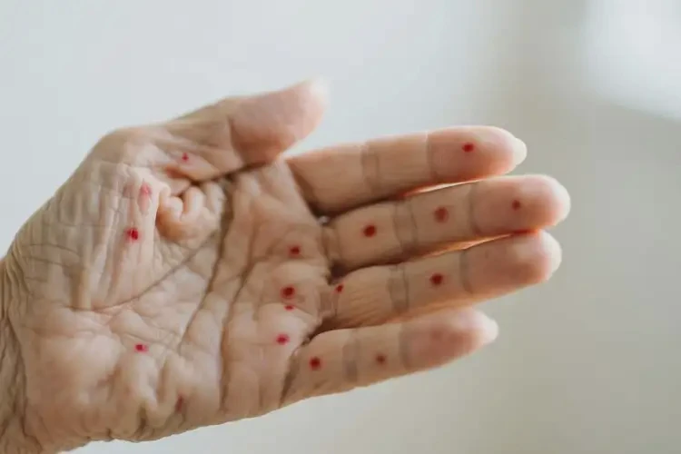 老人手上偶爾起濕疹不管它會(huì)自己好嗎(圖2)