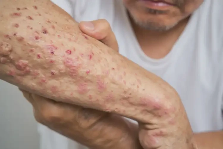 男生四肢有濕疹能靠自己自愈嗎(圖4)