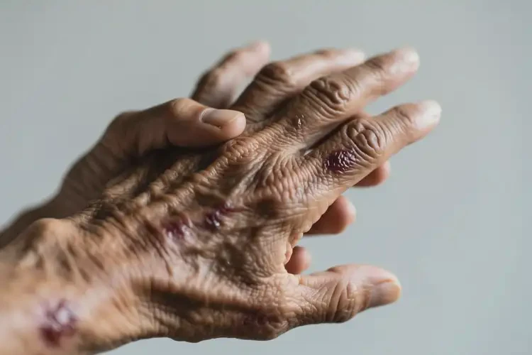 老人手上長濕疹不管它會自己好嗎(圖2)
