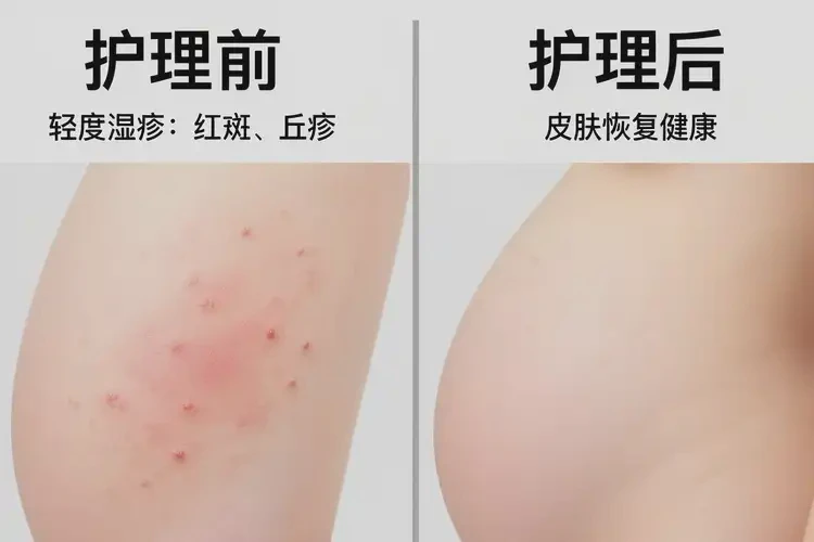 孕婦屁股上偶爾長濕疹不管它會自己痊愈嗎(圖1)