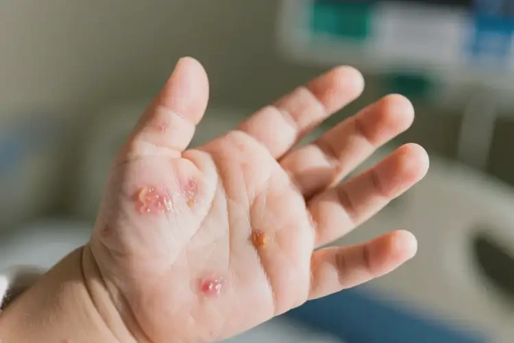 嬰兒手上經(jīng)常長濕疹不管它會自己痊愈嗎(圖4)