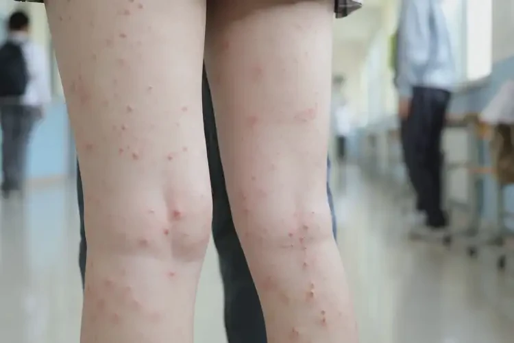 中學(xué)生小腿出濕疹不管它會自己好嗎(圖4)