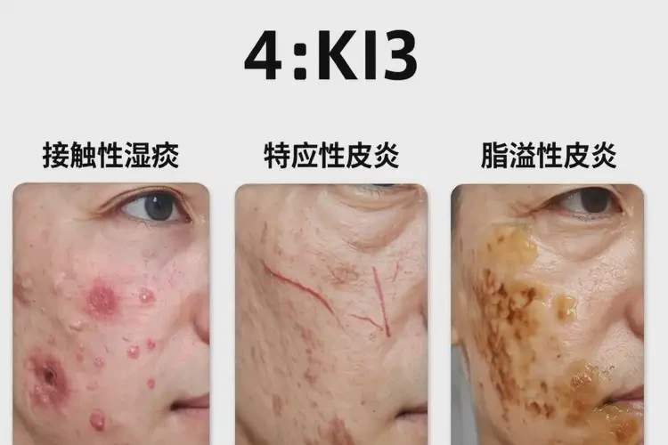 大學(xué)生面部有濕疹不管它會自己好嗎(圖4)