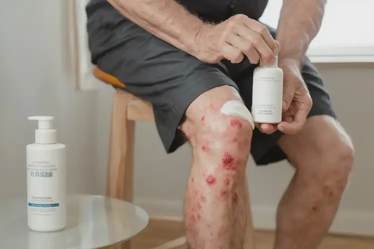 男性小腿上長濕疹不管它會自己好嗎(圖3)