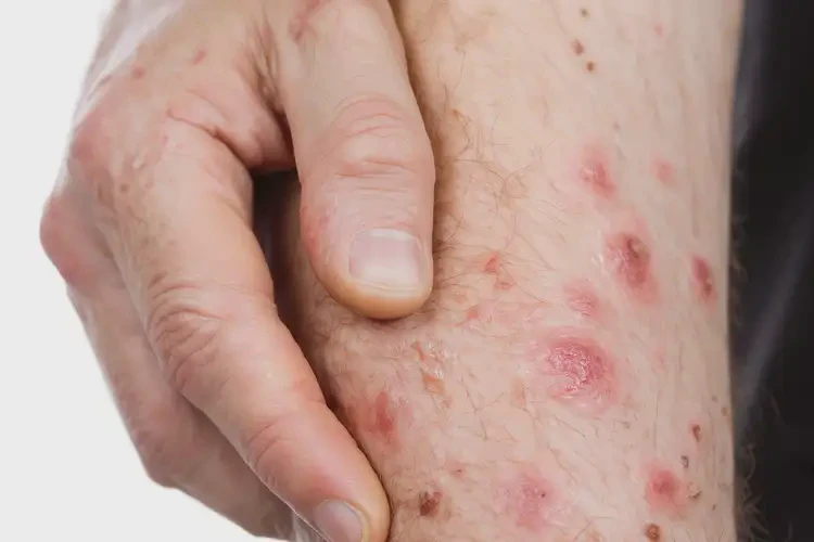 男生四肢起濕疹不管它會(huì)自己自愈嗎(圖4)