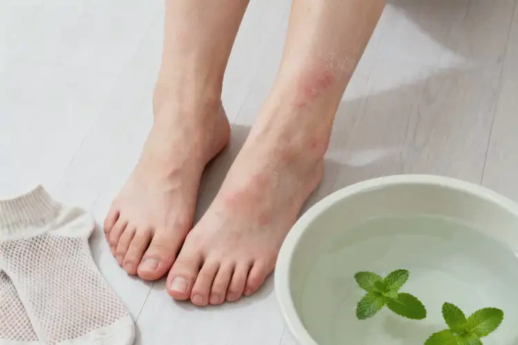 女性腳上偶爾起濕疹可以徹底自愈嗎(圖2)