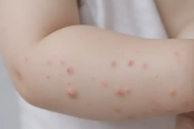 孩子身上偶爾起濕疹可不可以徹底自愈(圖4)