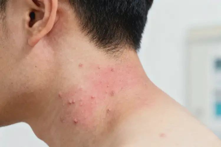 男人脖子上經(jīng)常起濕疹不管它會(huì)自己自愈嗎(圖1)