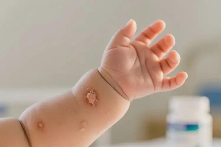 宝宝手臂上容易长湿疹不管它会自己自愈吗(图4)