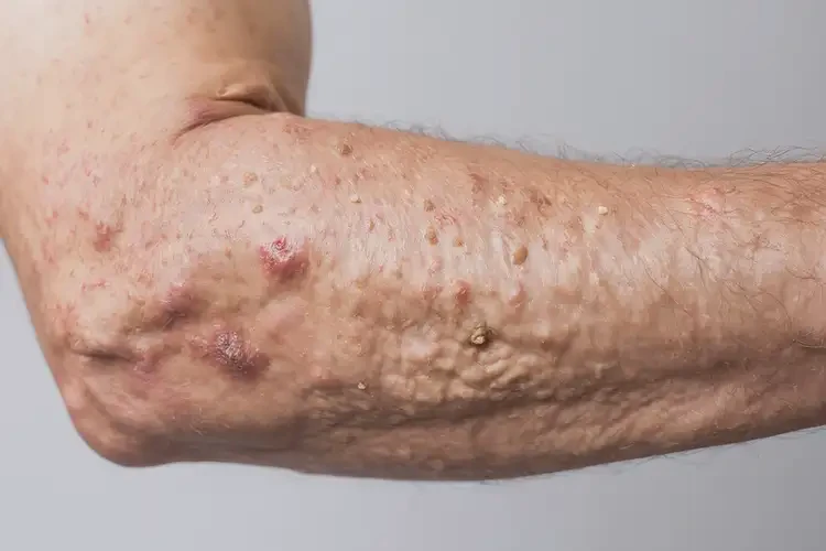 男人身上長(zhǎng)濕疹不管它會(huì)自己痊愈嗎(圖3)