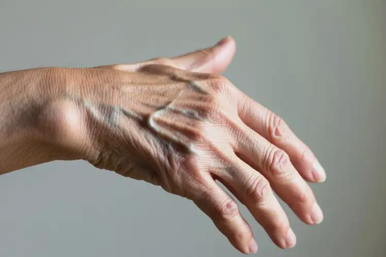高齡老人手上出現(xiàn)濕疹不管它會(huì)自己自愈嗎(圖2)