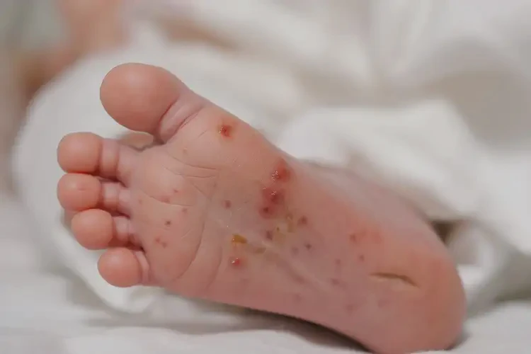 新生兒腳上經(jīng)常長濕疹能夠徹底治愈嗎(圖4)