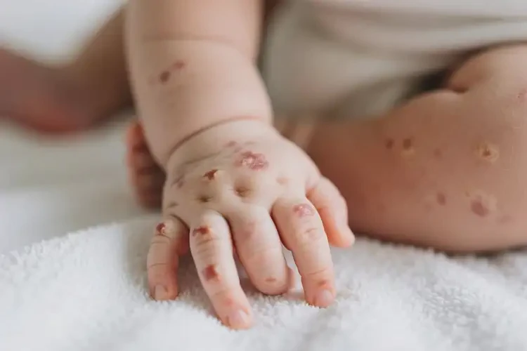 嬰兒身上有濕疹不管它會自己好嗎(圖3)