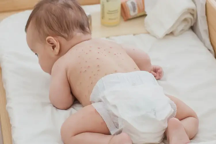 孩子屁股上容易起濕疹能徹底自愈嗎(圖4)