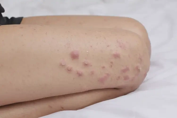 女生大腿上容易长湿疹能够彻底治愈吗(图4)