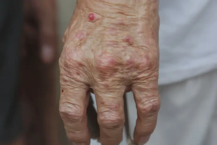 高齡老人手上偶爾起濕疹可以徹底自愈嗎(圖4)