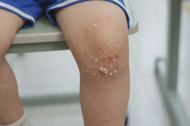 小學(xué)生小腿上起濕疹不管它會(huì)自己自愈嗎(圖4)