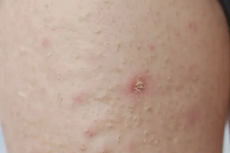 幼兒大腿上起濕疹能徹底自愈嗎(圖4)