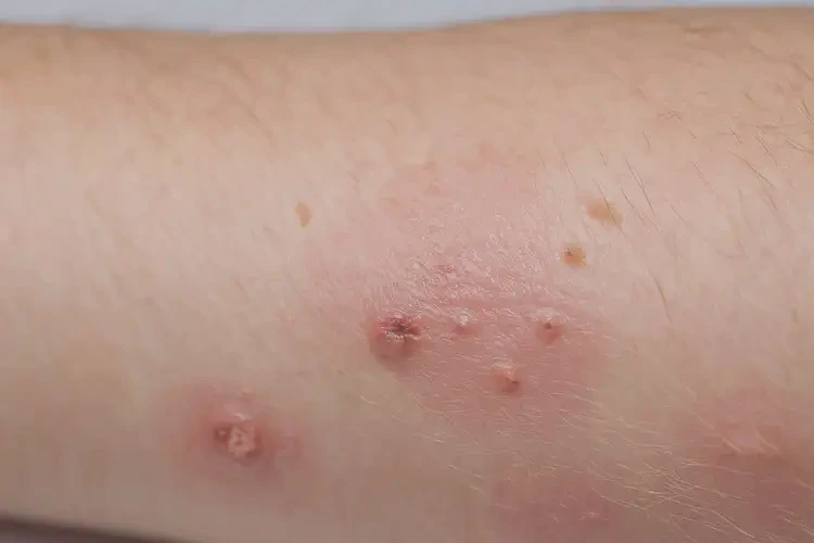 小孩手臂容易長(zhǎng)濕疹能夠徹底治愈嗎(圖4)