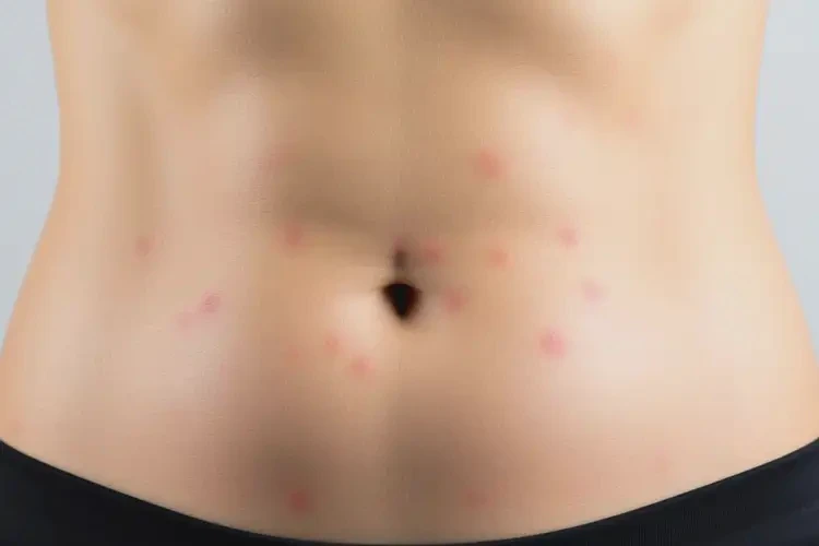 女性肚子起湿疹不管它会自己好吗(图4)