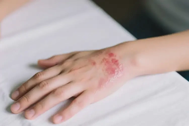 青少年手上出濕疹能徹底自愈嗎(圖2)