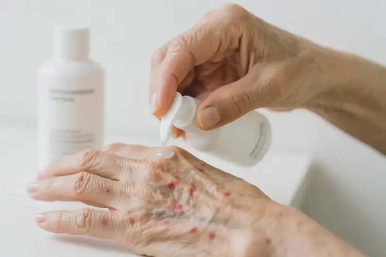 高齡老人手上起濕疹可不可以徹底自愈(圖2)