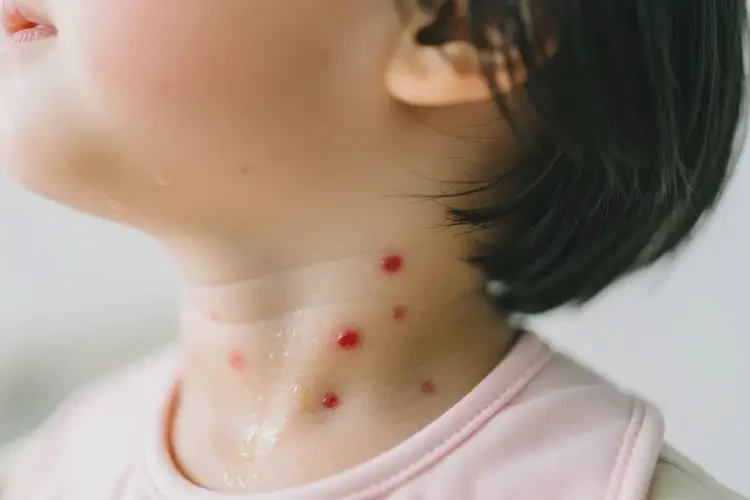 小孩脖子上偶尔起湿疹能彻底自愈吗(图2)